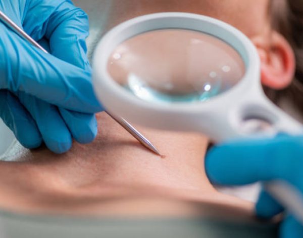 Dermatology treatment of warts, removal utilizing the power of radio waves. Treating warts and ensuring smooth and blemish-free skin.